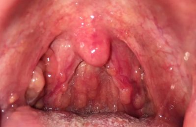 Viêm họng nổi hạch là một triệu chứng phổ biến xảy ra khi các mô trong họng bị viêm nhiễm