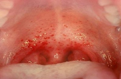 Viêm họng xuất huyết là tình trạng viêm nhiễm ở niêm mạc họng