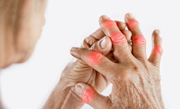 Viêm khớp tay là tình trạng viêm nhiễm ở các khớp ngón tay, cổ tay, và bàn tay