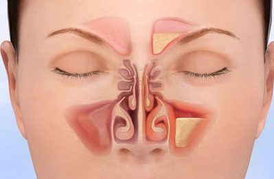 Viêm xoang thực chất là một bệnh lý liên quan đến viêm nhiễm ở các xoang mũi