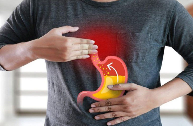 Bệnh trào ngược dạ dày thực quản k21 được mã hóa trong phân loại quốc tế ICD-10 với ký hiệu K21
