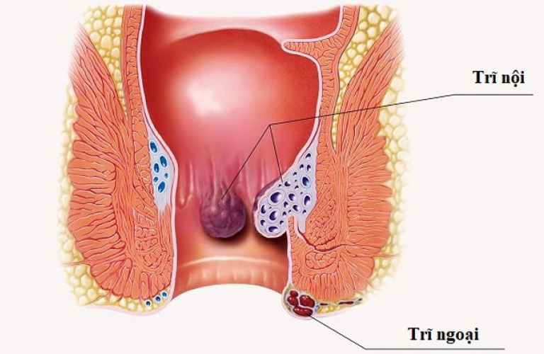 Bệnh trĩ là hiện tượng các đám rối tĩnh mạch ở vùng hậu môn
