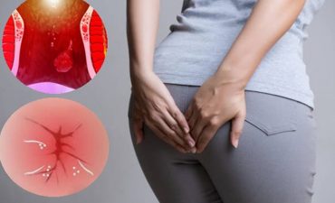 Bệnh trĩ không hoàn toàn tự khỏi nếu không có sự can thiệp và thay đổi thói quen sinh hoạt phù hợp