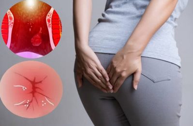 Bệnh trĩ không hoàn toàn tự khỏi nếu không có sự can thiệp và thay đổi thói quen sinh hoạt phù hợp