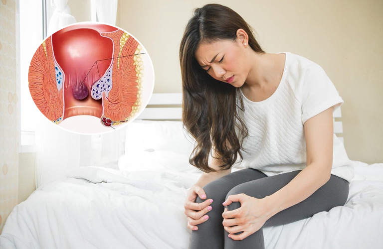 Bệnh trĩ sau sinh là một bệnh lý thường gặp ở phụ nữ, đặc biệt là những bà mẹ vừa trải qua quá trình sinh đẻ