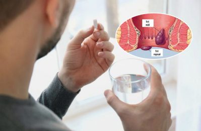 Bệnh trĩ uống thuốc có thể khỏi trong một số trường hợp