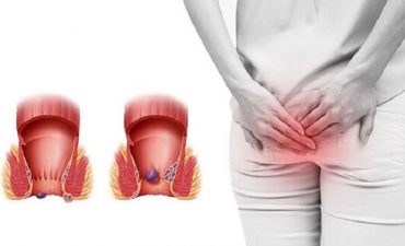 Lòi dom sau sinh, còn gọi là sa búi trĩ sau sinh, là tình trạng phần tĩnh mạch vùng hậu môn bị phình giãn