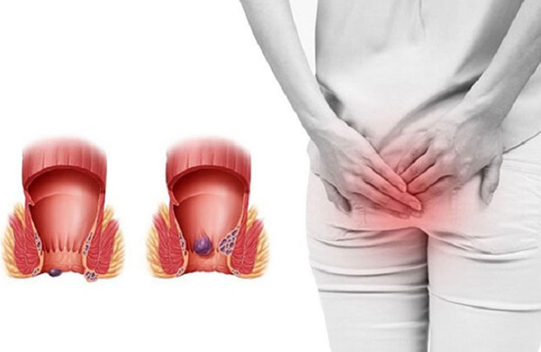 Lòi dom sau sinh, còn gọi là sa búi trĩ sau sinh, là tình trạng phần tĩnh mạch vùng hậu môn bị phình giãn