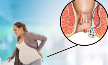 Bị trĩ khi mang bầu là tình trạng các tĩnh mạch ở hậu môn và trực tràng bị giãn nở quá mức, dẫn đến việc hình thành các búi trĩ