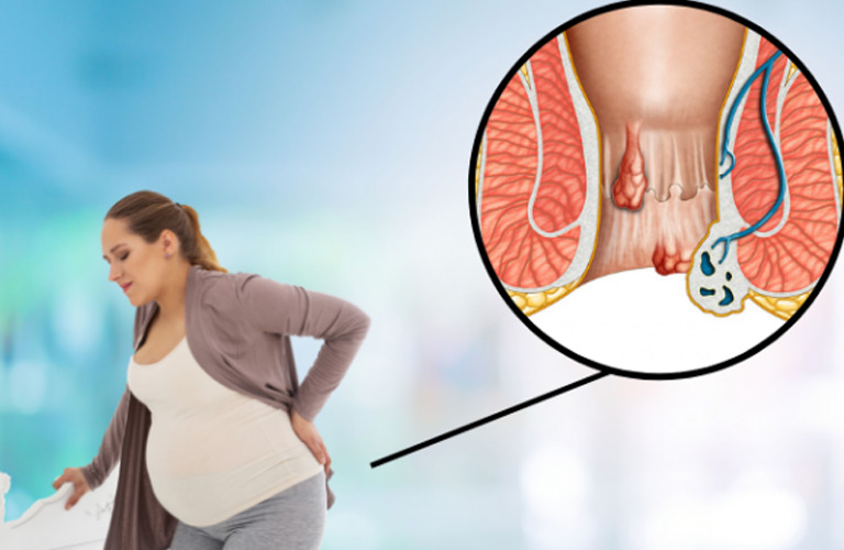 Bị trĩ khi mang bầu là tình trạng các tĩnh mạch ở hậu môn và trực tràng bị giãn nở quá mức, dẫn đến việc hình thành các búi trĩ