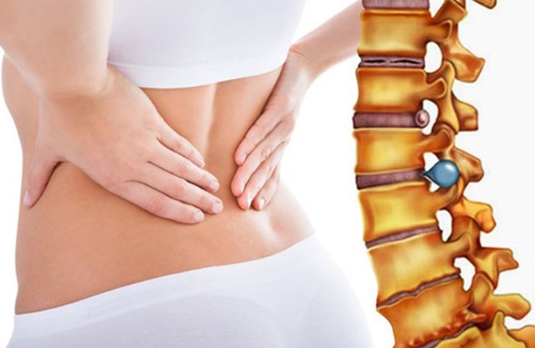 Thoát vị đĩa đệm vùng cổ chèn ép dây thần kinh, làm xuất hiện đau khi thay đổi tư thế