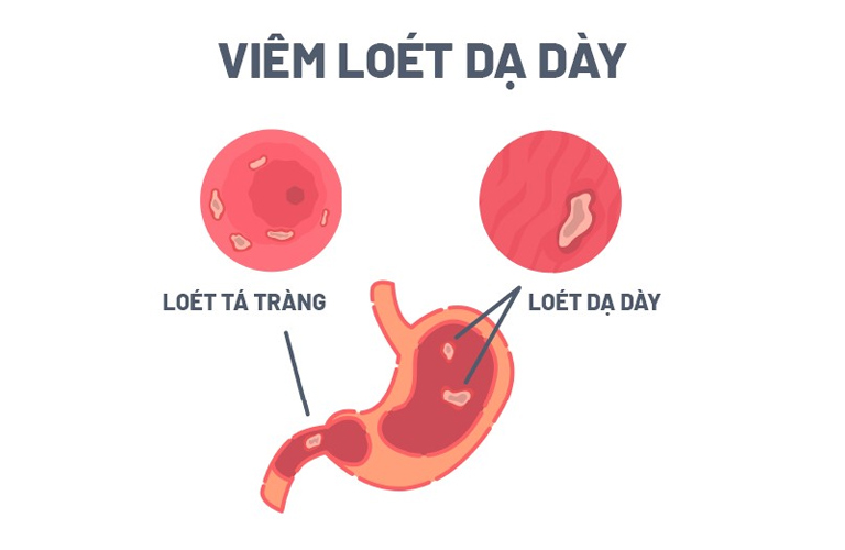 Tổn thương lớp niêm mạc gây chảy máu, bà con có thể nôn ra máu đỏ tươi hoặc lẫn máu đen