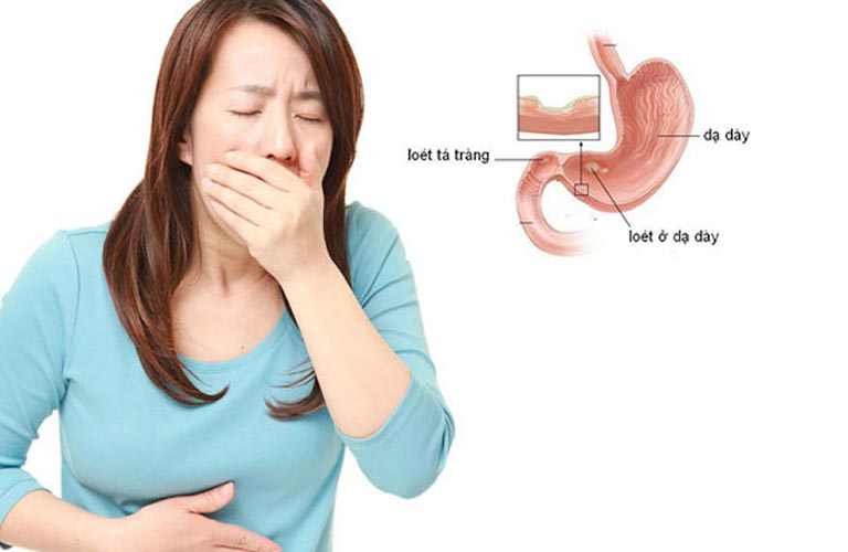 Đau dạ dày buồn nôn là tình trạng phổ biến mà nhiều bà con gặp phải trong cuộc sống hàng ngày