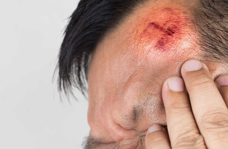 Những chấn thương nhẹ ở đầu cũng có thể gây ra cơn đau đầu kéo dài, đôi khi chỉ xuất hiện ở một bên
