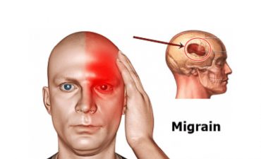 Đau đầu migraine là tình trạng đau đầu nghiêm trọng, thường xảy ra một bên đầu