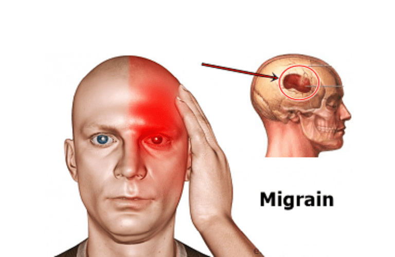 Đau đầu migraine là tình trạng đau đầu nghiêm trọng, thường xảy ra một bên đầu