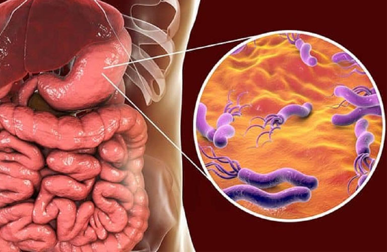 HP dương tính là tình trạng trong dạ dày có sự hiện diện của vi khuẩn Helicobacter pylori