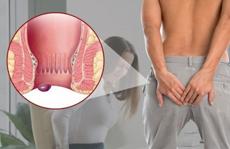 Lòi dom là cách gọi dân gian của bệnh trĩ – tình trạng các đám rối tĩnh mạch ở vùng hậu môn bị giãn quá mức