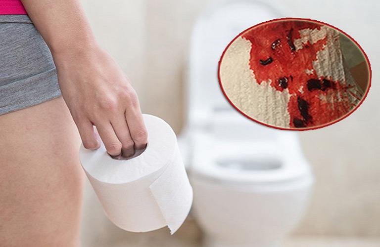 Máu thường nhỏ giọt hoặc vệt đỏ, xuất hiện sau mỗi lần đi tiêu