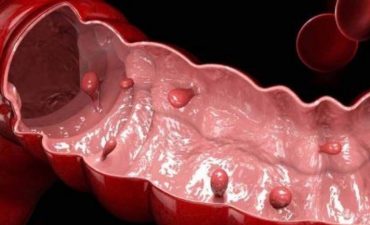 Polyp đại tràng là những khối u nhỏ phát triển trong lòng đại tràng, có thể lành tính hoặc có nguy cơ biến thành ung thư