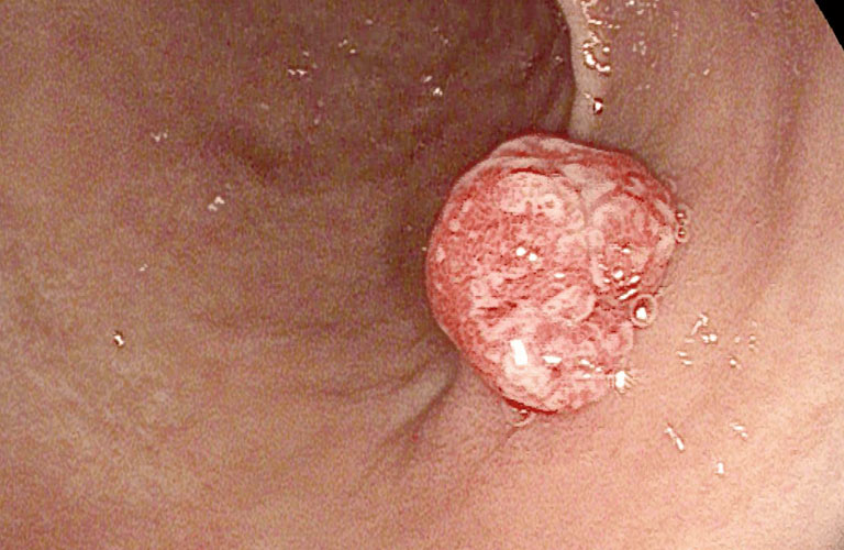 Polyp hang vị dạ dày là những khối u lành tính xuất hiện trong niêm mạc dạ dày, thường tại vùng hang vị