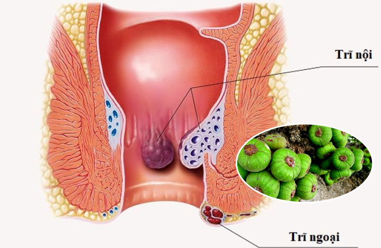 Tác dụng của quả sung chữa bệnh trĩ