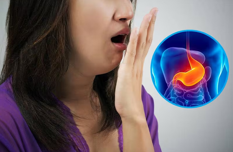 Trào ngược dạ dày là tình trạng axit dạ dày trào ngược lên thực quản và thậm chí có thể lên đến cổ họng