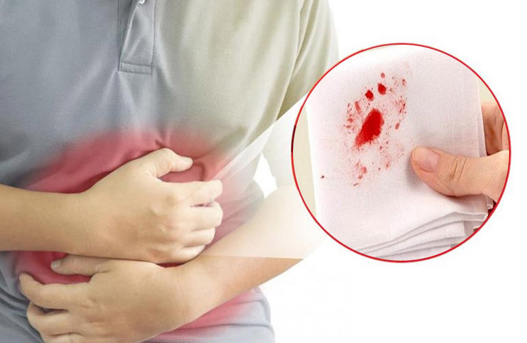 Trào ngược dạ dày ra máu là tình trạng acid dịch vị cùng với máu thoát ngược lên thực quản