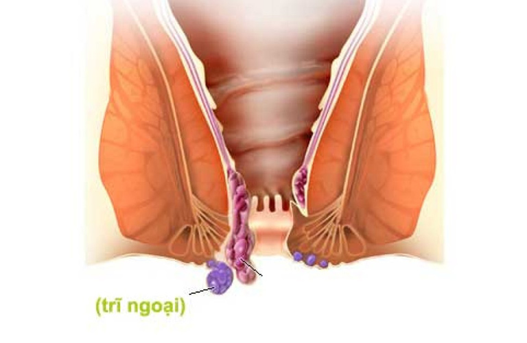 Trĩ ngoại là tình trạng các búi tĩnh mạch nằm ở phía ngoài ống hậu môn bị giãn phồng, sưng to