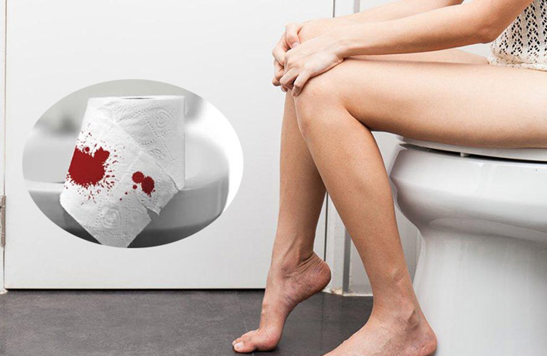 Lúc đầu thường nhỏ như hạt đậu, mềm, không đau nhưng gây cảm giác vướng víu khi đi đại tiện
