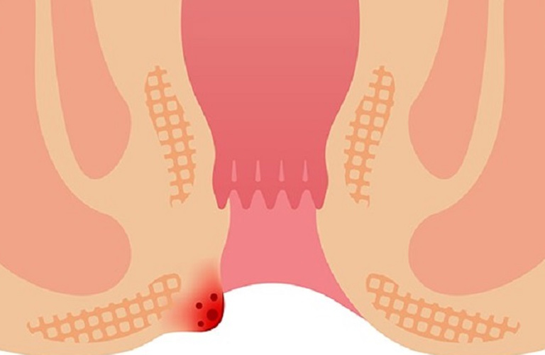 Trĩ ngoại độ 1 là giai đoạn các búi trĩ bắt đầu hình thành bên ngoài ống hậu môn