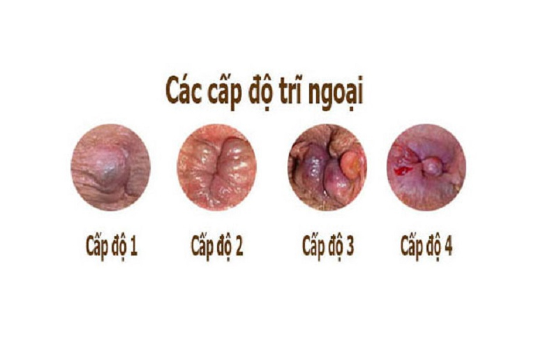 Trĩ ngoại độ 2 là tình trạng búi trĩ phát triển to hơn so với độ 1