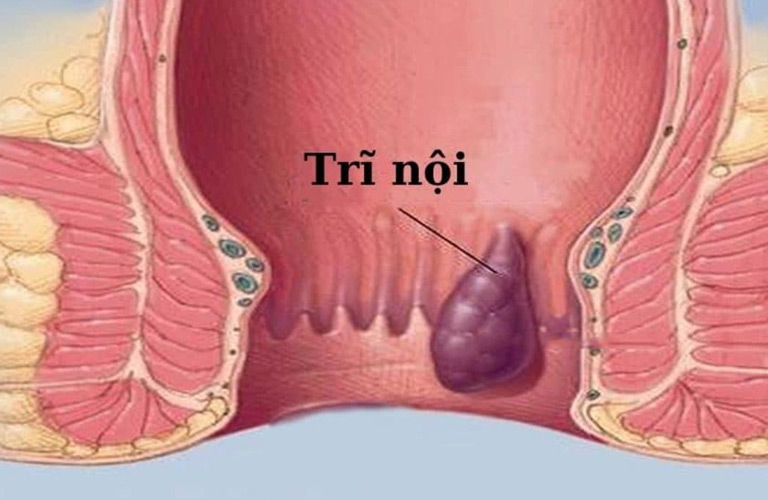 Trĩ nội là tình trạng các tĩnh mạch nằm trong ống hậu môn bị giãn quá mức, tạo thành búi trĩ nằm ở phía trên đường lược