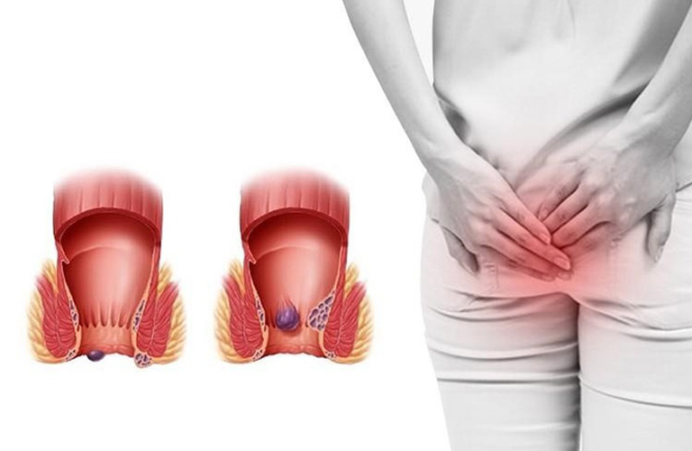 Sau mỗi lần đại tiện, bà con sẽ thấy như có vật gì đó lấn cấn bên trong