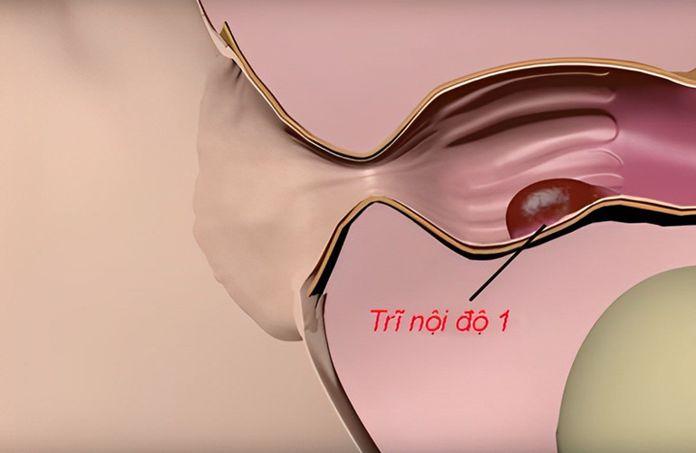 Trĩ nội độ 1 là tình trạng giãn tĩnh mạch ở phần trên đường lược trực tràng