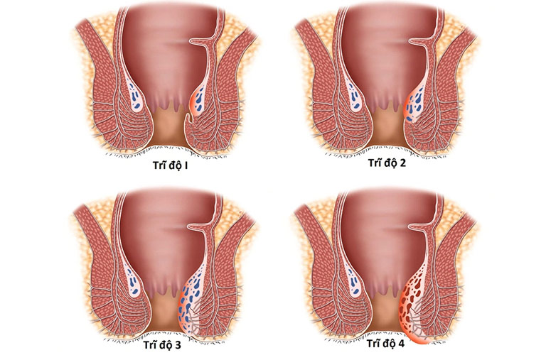 Trĩ nội độ 3 là giai đoạn mà búi trĩ đã sa ra ngoài hậu môn mỗi khi bà con đi đại tiện