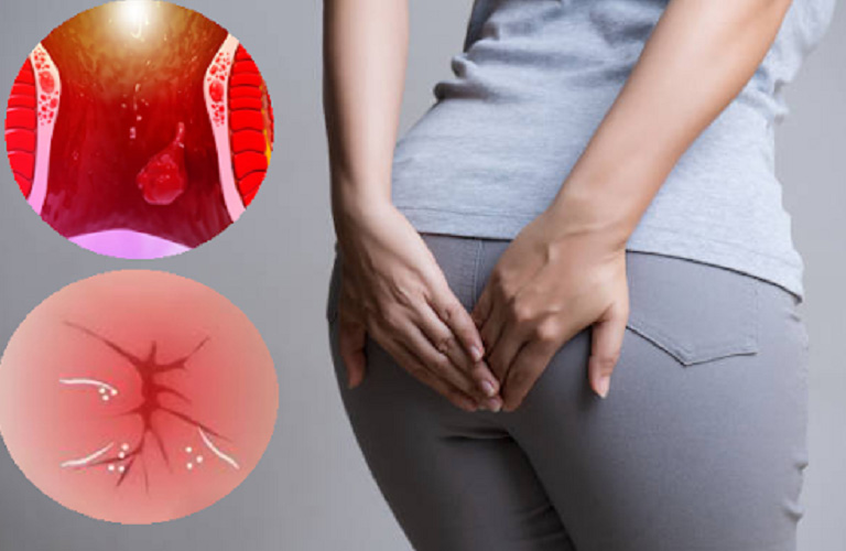 Nhiều người thấy không “hết phân”, muốn đi hoài không xong, thực chất là búi trĩ bắt đầu xuất hiện nhẹ