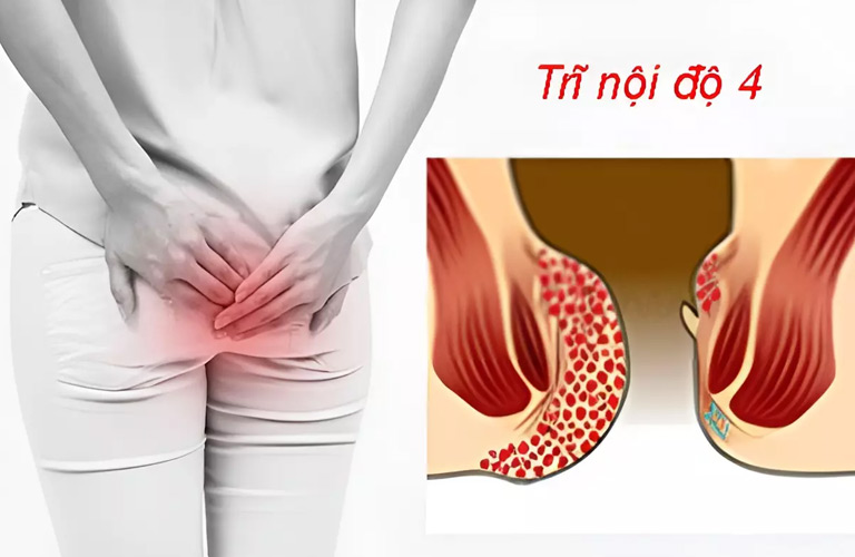 Trĩ nội độ 4 là giai đoạn nặng nhất của bệnh trĩ, khi búi trĩ sa hẳn ra ngoài hậu môn