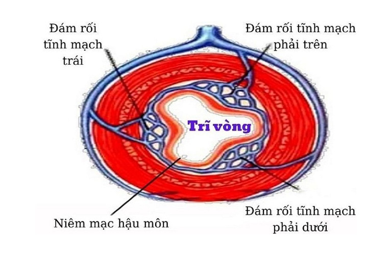 Trĩ vòng là tình trạng búi trĩ phát triển liên kết thành một vòng tròn khép kín quanh ống hậu môn