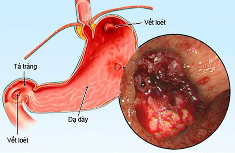 Viêm dạ dày là tình trạng lớp niêm mạc trong dạ dày bị tổn thương do phản ứng viêm