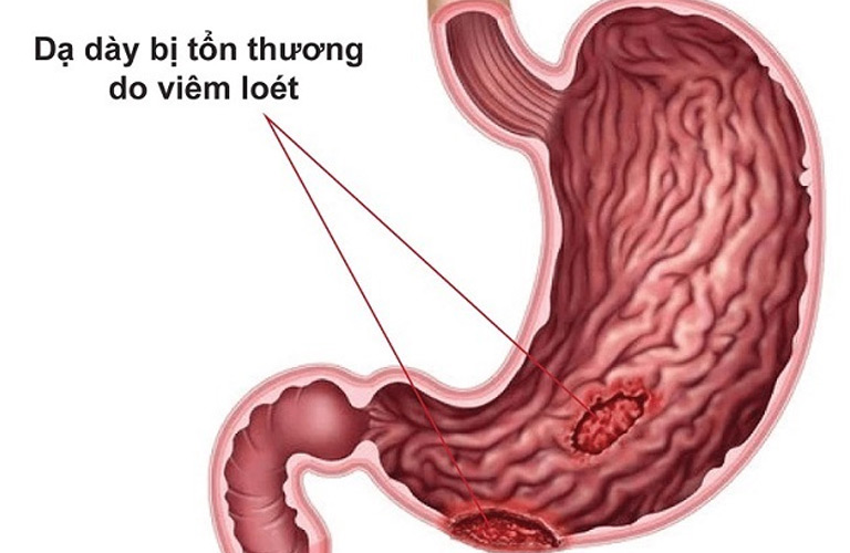 Viêm dạ dày mạn tính là tình trạng viêm kéo dài ở niêm mạc dạ dày