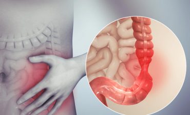 Viêm đại tràng là tình trạng lớp niêm mạc của đại tràng (ruột già) bị tổn thương, viêm loét kéo dài