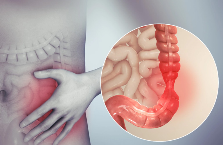 Viêm đại tràng là tình trạng lớp niêm mạc của đại tràng (ruột già) bị tổn thương, viêm loét kéo dài