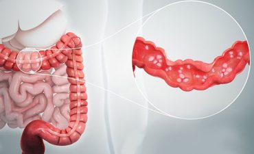 Viêm đại tràng cấp là tình trạng viêm cấp tính xảy ra tại lớp niêm mạc của đại tràng