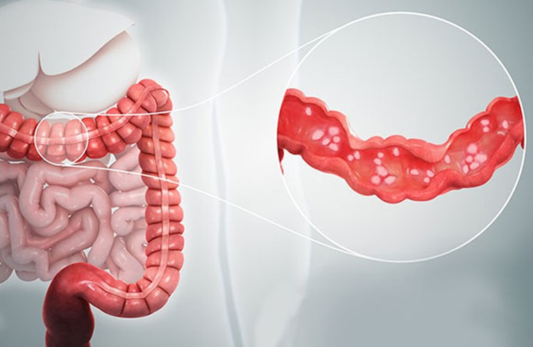 Viêm đại tràng cấp là tình trạng viêm cấp tính xảy ra tại lớp niêm mạc của đại tràng