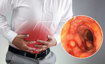 Viêm đại tràng mãn tính với biểu hiện đau bụng âm ỉ, đi ngoài thất thường, kéo dài hàng tháng trời