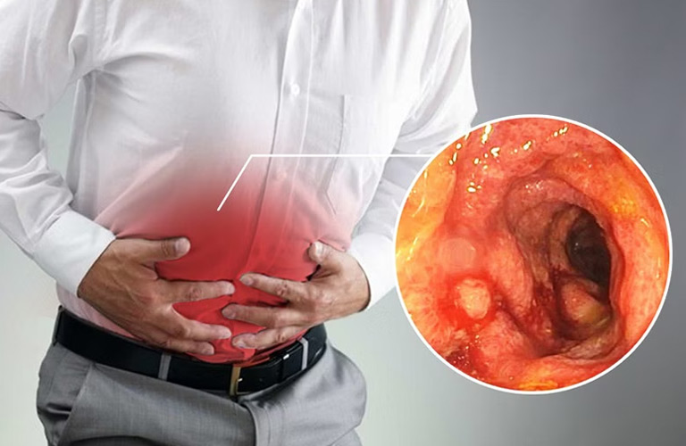 Viêm đại tràng mãn tính với biểu hiện đau bụng âm ỉ, đi ngoài thất thường, kéo dài hàng tháng trời