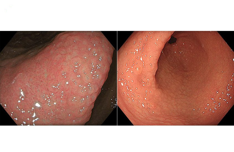 Viêm dạng nốt hang vị là một bệnh lý liên quan đến tổn thương niêm mạc dạ dày