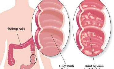 Viêm loét đại tràng là một bệnh lý mạn tính của đường tiêu hóa