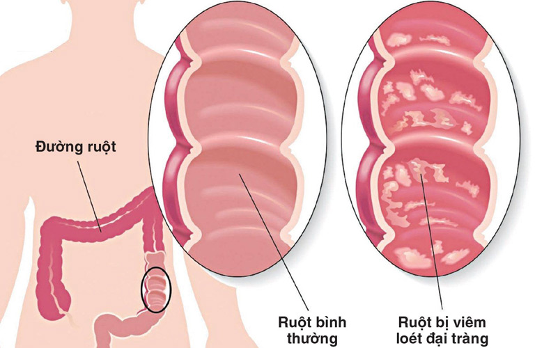 Viêm loét đại tràng là một bệnh lý mạn tính của đường tiêu hóa